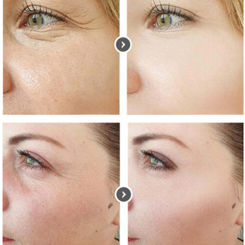 Before and after skincare results showing reduced wrinkles and smoother skin with Curenex Salmon DNA product.