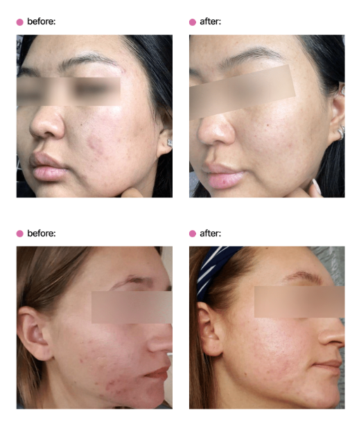 Before and after photos showing skin improvement after using Jeunetique EXO serum.