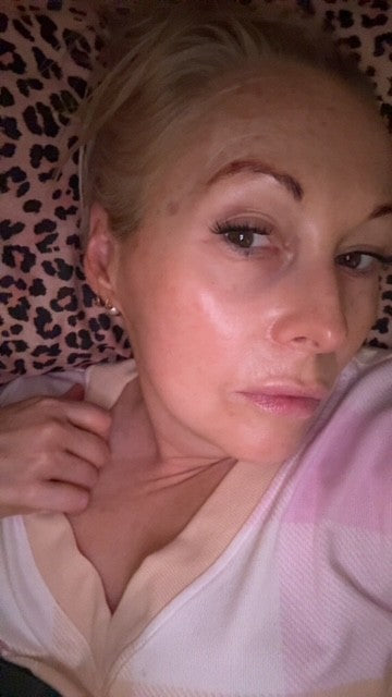 Microneedling before and after at home in Australia: Michelle, 52, after consistent Salmon DNA PDRN skincare