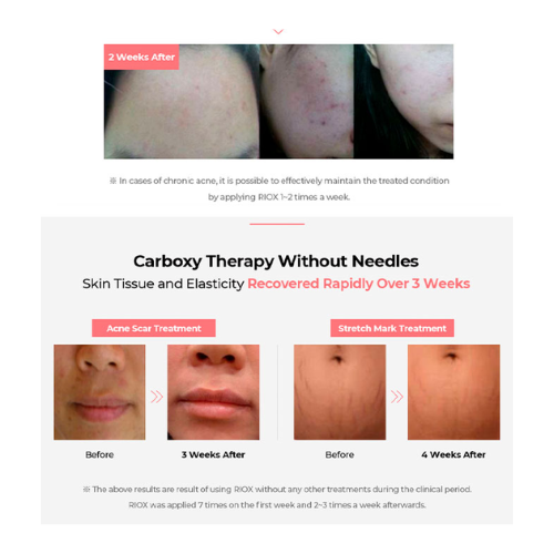 Riox carboxy therapy masks for acne scar and stretch mark treatment, skin repair and improved elasticity, 5 treatments per box