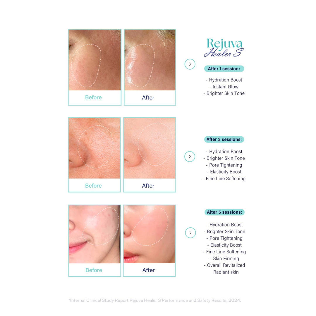 Rejuva Healer S skin booster before and after results showing improved hydration, brighter skin tone, pore tightening, elasticity boost, fine line softening, and skin firming after multiple sessions.