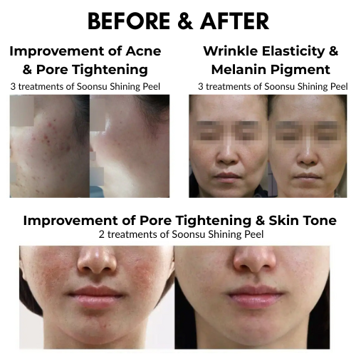 Before and after results of Soonsu Shining Peel showcasing pore tightening, acne reduction, and improved skin tone.